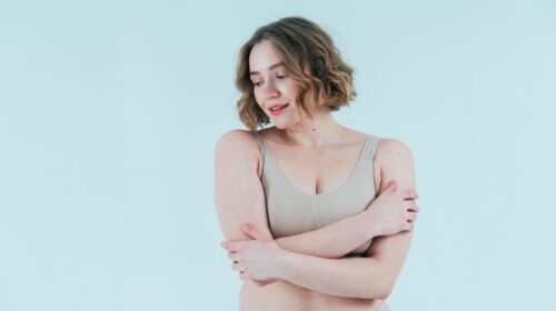 Lipedema