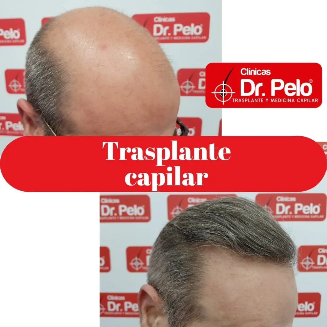 injerto capilar