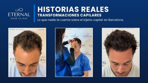 injerto capilar Barcelona